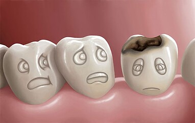 چرا کنترل پوسیدگی‌های دندانی در مراحل اولیه اهمیت حیاتی دارد؟ 